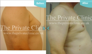 Male chest reduction through Micro Lipo. 