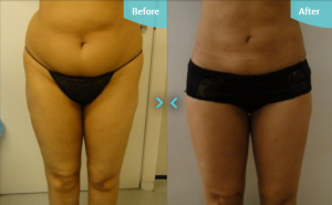 Before and after MicroLipo The Private Clinic