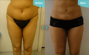 Before and after MicroLipo to the abdomen and thighs, performed by Dr. Gupta at The Private Clinic.