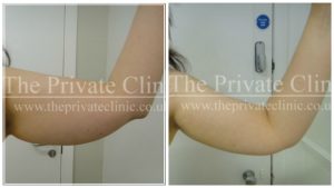 arm fat liposuction the private clinic