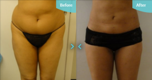 abs flanks thighs liposuction before after photo