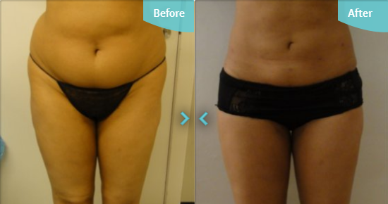 Liposuction to love handles: good results vs great results