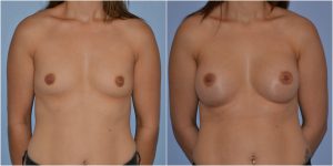Natural breast augmentation before after photo
