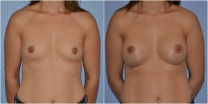 Natural breast augmentation before after photo