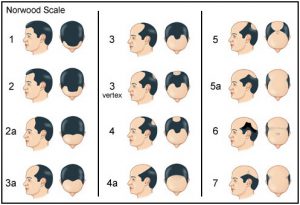 Male Pattern Hair Loss Hamilton-Norwood Scale