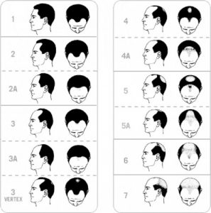 Norwood hair loss scale why hair loss occurs