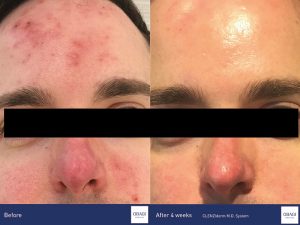 Acne treatment before and after results with Obagi Clenziderm Products