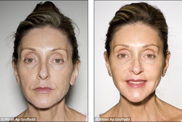 Organic Facelift Fat Transfer to the Face Anti-Ageing Before and After