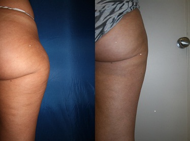 Vaser Liposuction Pros & Cons Vs. Traditional Liposuction