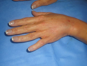 The Private Clinic: Hand Rejuvenation