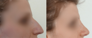 Before and after Rhinoplasty treatment by The Private Clinic's Mr. Davood Fallahdar. 