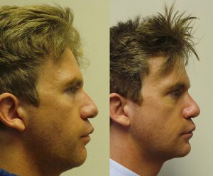 Rhinoplasty male before and after photos