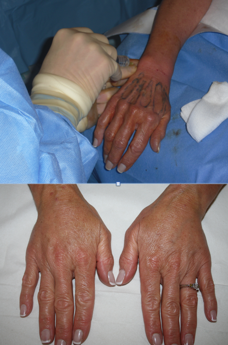 The Private Clinic: Hand Rejuvenation