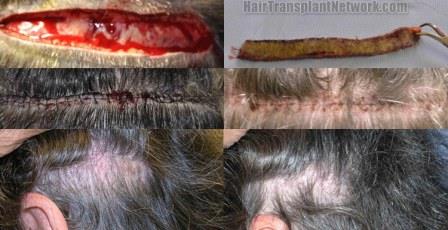 FUE Hair Transplant Los Angeles  Dr Sean Behnam