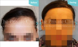 Traction alopecia before and after the private clinic treatment results