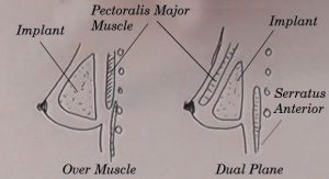 Under over muscle breast implant