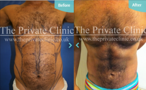 VASER Hi-Def treatment before after The Private Clinic 