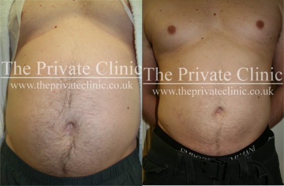 Before and After VASER Lipo at The Private Clinic