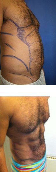 VASER Hi-Def Lipo by Dr Dennis Wolf at The Private Clinic