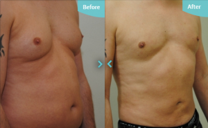 Before and after VASER treatment on the abdomen and for Male Breast Reduction at The Private Clinic. 