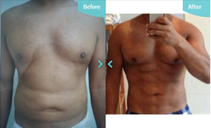 Before and after VASER Hi-Def. Performed by The Private Clinic's Dr Edwin Anthony. 