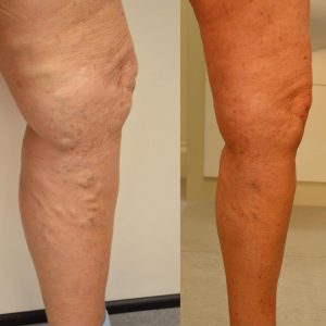 Varicose Veins Before and After photo