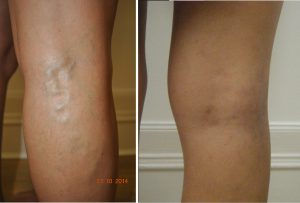 Treatment for Spider Veins & Varicose Veins - Holy Cross Medical Center