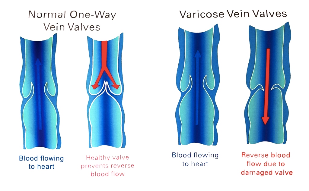 Varicose Veins copy