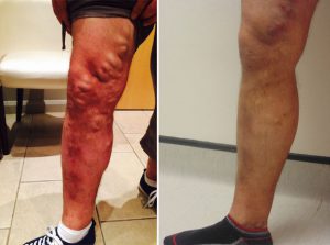 Before and after EVLA veins treatment