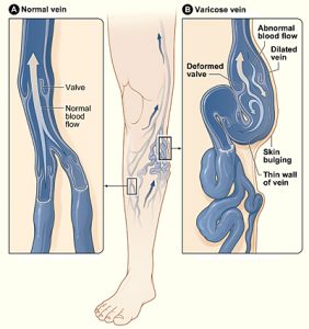 Varicose vein information treatment