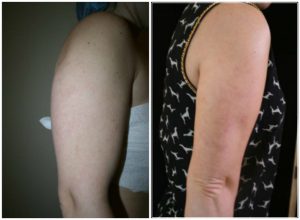 Vaser Liposuction arms before and after photo The Private Clinic