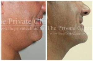 Vaser Liposuction chin before and after the private clinic