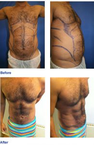 Vaser high def - before and after dr Wolf