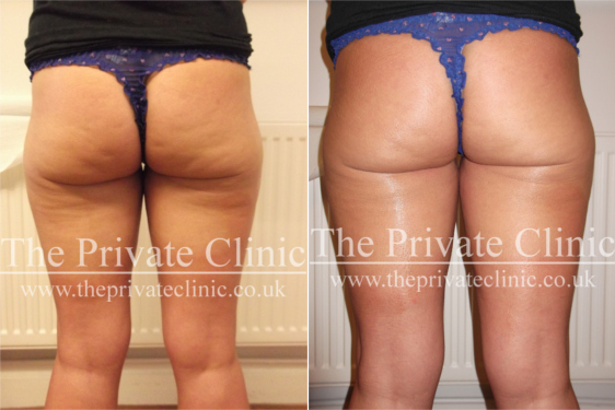 Before and After Velashape Cellulite Treatment at The Private Clinic