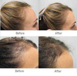 hair loss trichology treatments before after photo