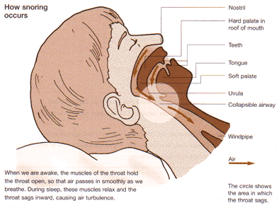 What causes snoring