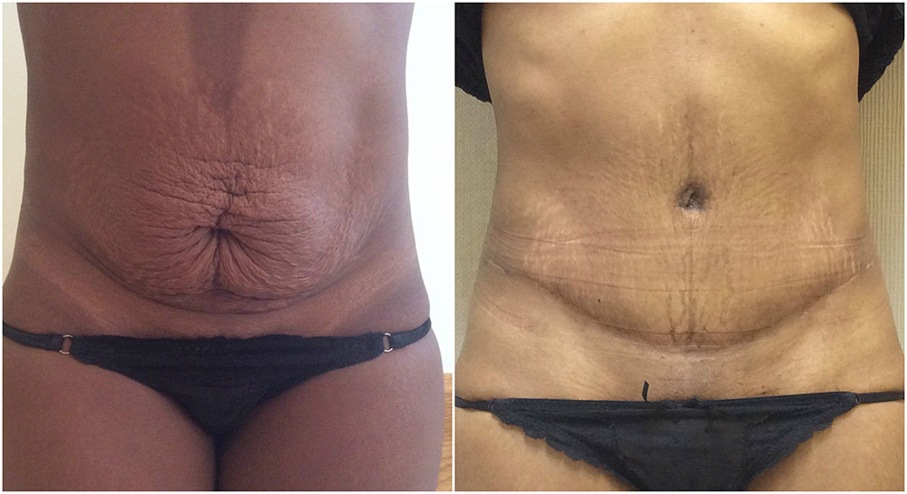 Simple Aftercare: 5 Tummy Tuck Recovery Tips - Harley Clinic