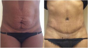 abdominoplasty before after the private clinic