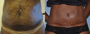 abdo surgery tummy tuck before after patient story