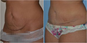 abdominoplasty before after photo mr adrian richards
