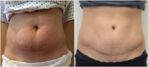 abdominoplasty tummy tuck before after photo