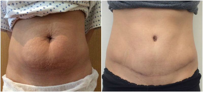 tummy tuck before after images.