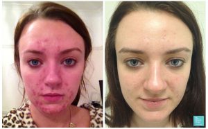 Before and after N-Lite laser acne treatment.