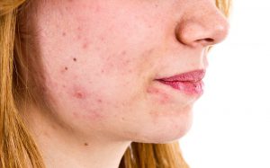 acne treatment private clinic london