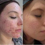 acne treatment before after photo