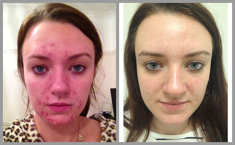 Rektangel Gå forud Scan Acne Laser Treatment Pros and Cons, Best Acne Treatment to Get Rid of Acne