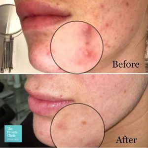 Before and after Chemical Peel Acne treatment at The Private Clinic