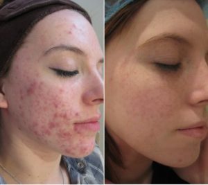 Before and after acne treatment at The Private Clinic.