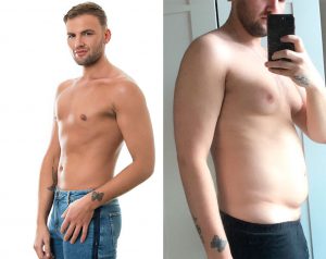 male chest reduction before after photos patient story review