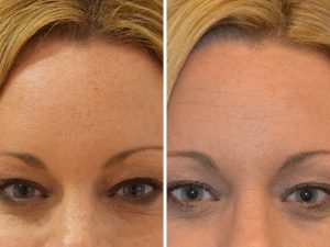 Anti-wrinkle injections to forehead before and after photo